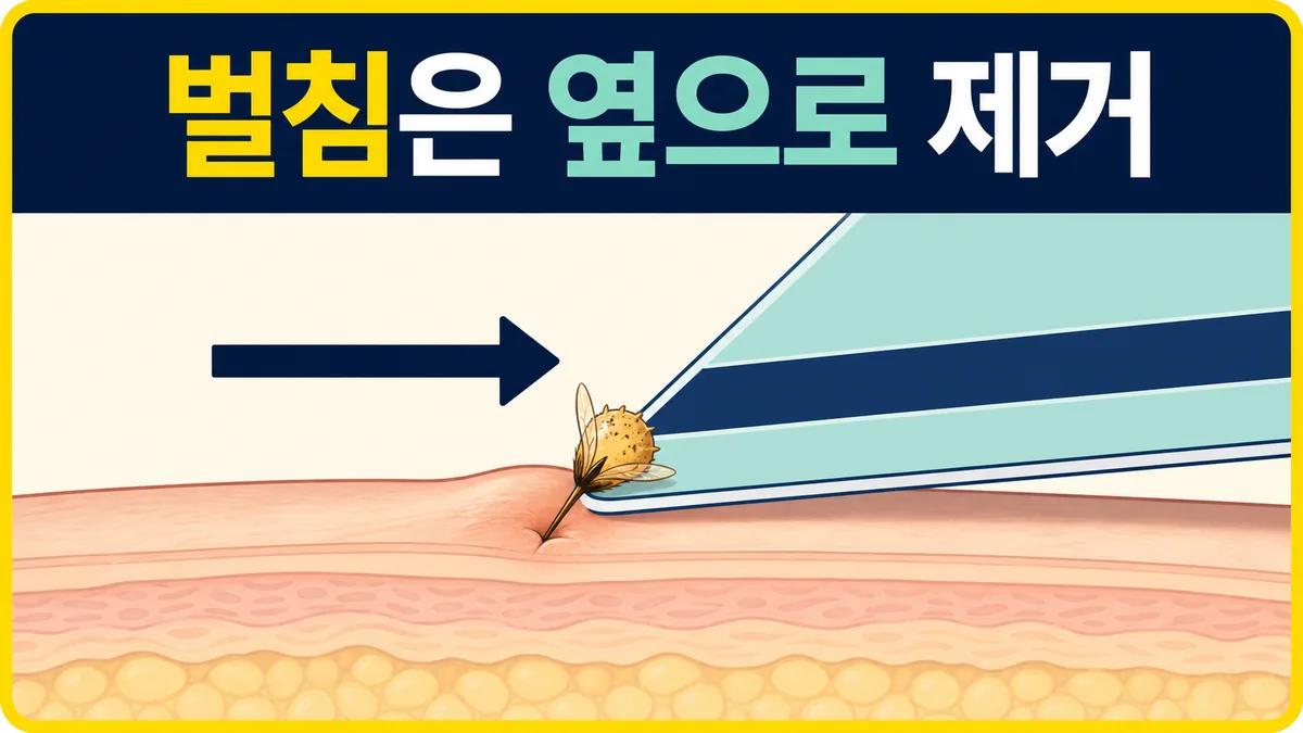 피부에 남은 벌침을 카드 모서리로 피부와 평행하게 옆으로 긁어 제거하는 방법